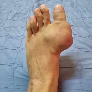 bengkak gout makin kronik